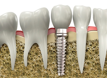 model of a dental implant post in the jawbone 