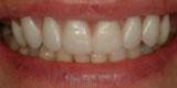 Closeup of smile with full upper arch dental implant retained denture