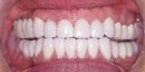 Smile with missing bottom teeth replaced with dental implants