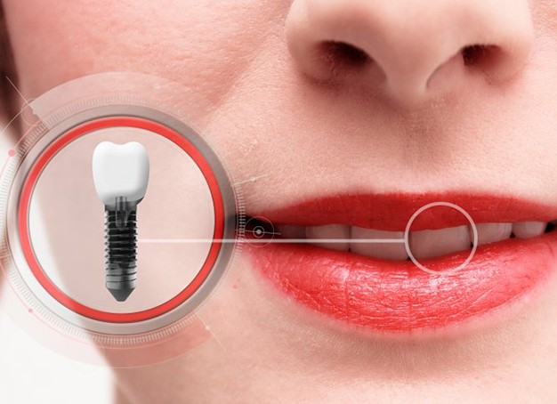 close-up of a woman with a dental implant in Parsippany