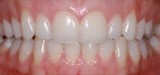 Overbite corrected by Invisalign treatment