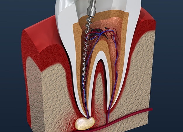 Animated tooth during the root canal therapy process