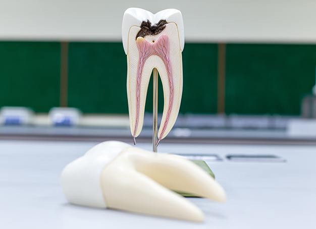 Model tooth in need of root canal therapy