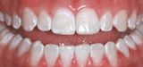 Closeup white smile after teeth whitening
