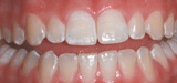 Closeup discolored smile before teeth whitening