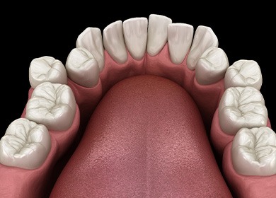 Illustration of crooked teeth