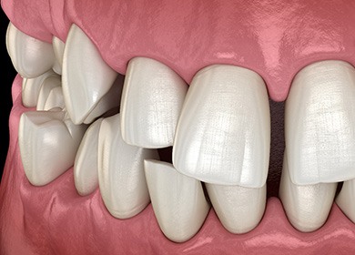 Illustration of gapped teeth