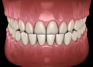 Illustration of an underbite