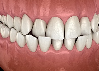 Illustration of a crossbite