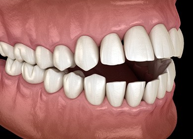 Illustration of an open bite