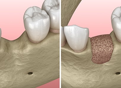 illustration of a patient’s jawbone before and after bone grafting in Parsippany 