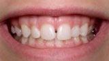 Smile with gap between front teeth before porcelain veneers
