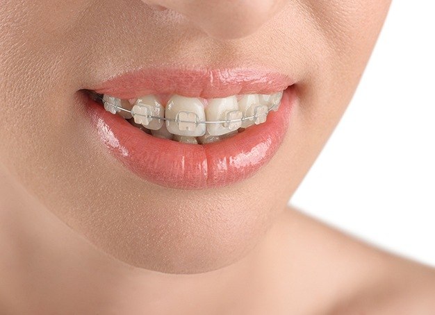 Closeup of smile with ceramic braces
