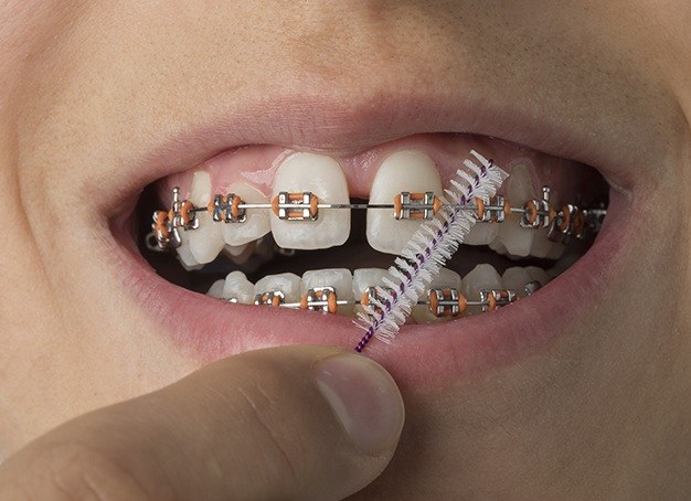 Patient caring for traditional braces