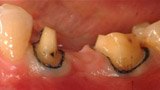 Broken and missing teeth before fixed bridge restoration