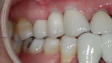 Smile with upper tooth replaced with fixed bridge