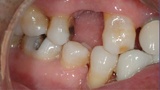 Smile with missing upper tooth before fixed bridge placement