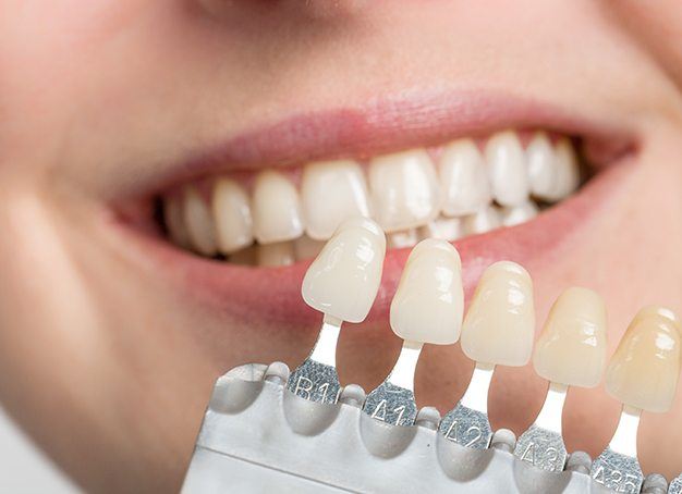 Smile compared to porcelain veneer shades during cosmetic dentistry
