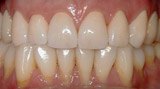 Healthy bright smile after dental crowns
