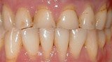 Yellowed and decayed teeth before dental crowns