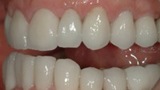 Smile with new natural looking dental crowns