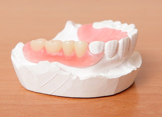 Model smile with partial denture restoration