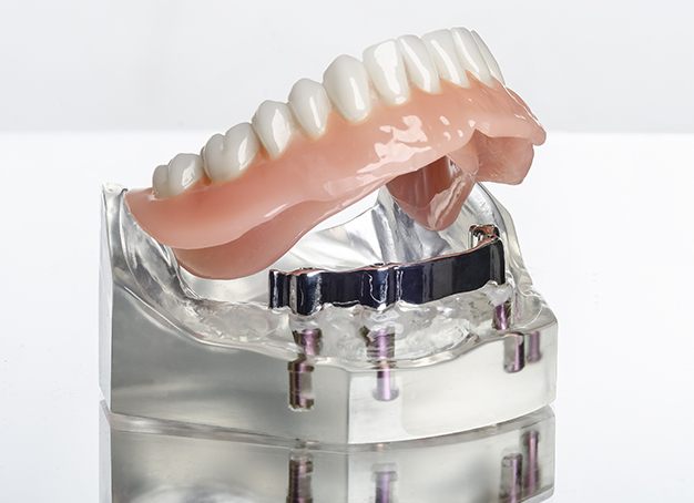 Model dental implant retained denture