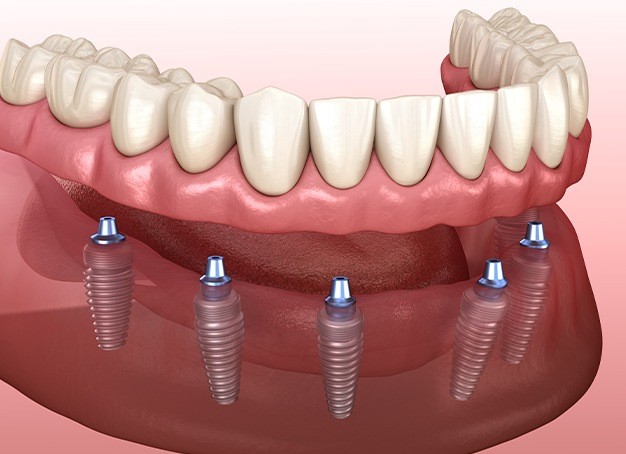 Animated dental implant supported dentures