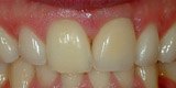 Smile flawlessly restored after dental implant restoration