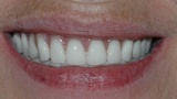 Closeup of smile with full upper and lower dental implant dentures