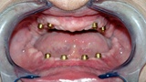 Closeup of smile with no healthy teeth reamining