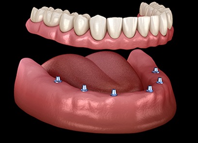 implant denture being placed onto mini dental implants
