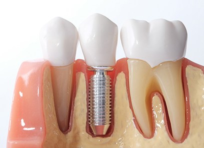 model of a dental implant in the jaw