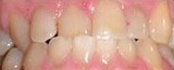 Misaligned teeth before Invisalign clear braces