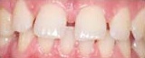 Smile with gaps between teeth before Invisalign