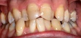 Crooked and misaligned smile before Invisalign