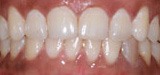 Smile with even spacing after Invisalign