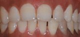 Smile with uneven spacing before Invisalign