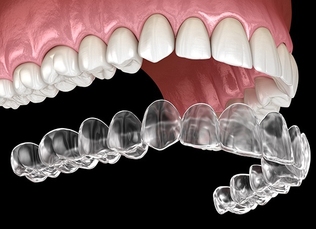Animated smile during placement of Invisalign tray