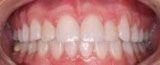 Even and aligned smile after Invisalign treatment