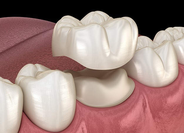 Animated smile during metal free dental crown restoration placement