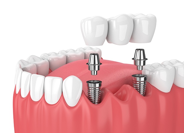 Model smile with dental implant supported fixed bridge replacing missing teeth