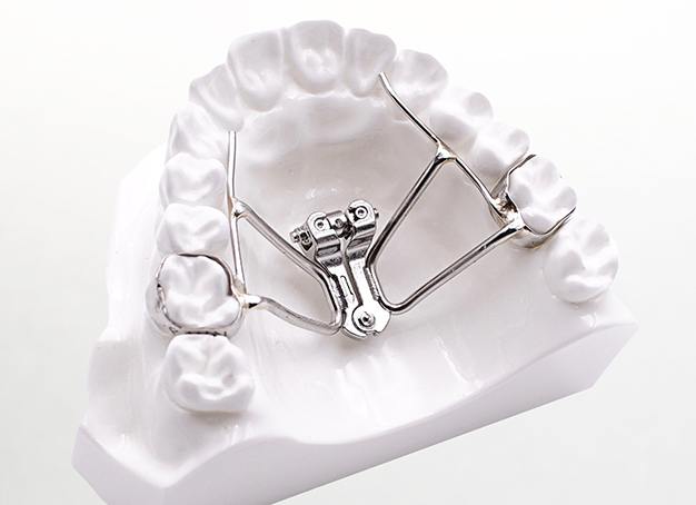 Model smile with palatal expander