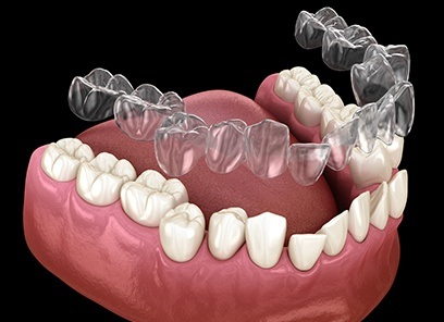 Animated smile during Invisalign clear braces treatment