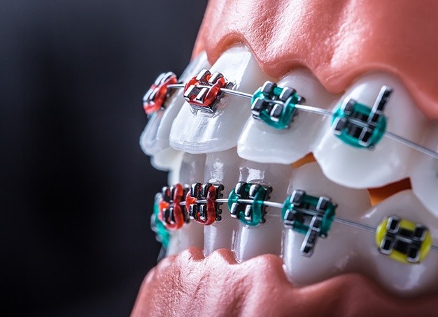 Animated smile with traditional braces