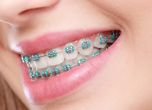 Closeup of smile with traditional braces