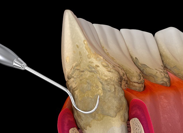 Animated smile during periodontal therapy for gum disease