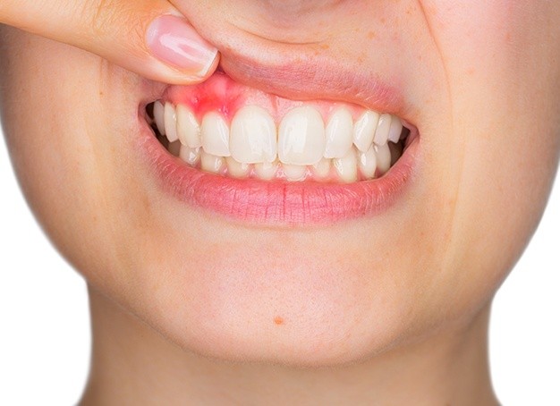 Woman with inflamed soft tissue caused by gum disease