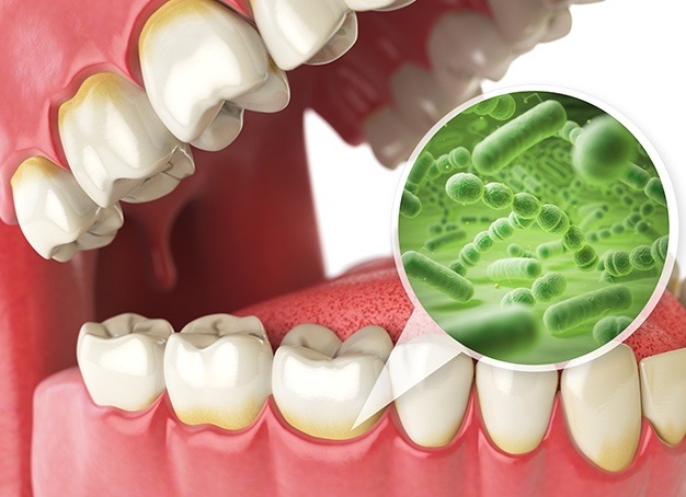 Animated smile with enlarged bacteria