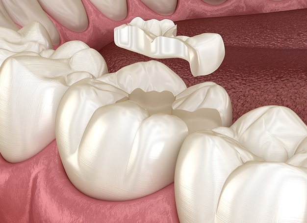 Animated smile during tooth colored filling restorative dentistry treatment